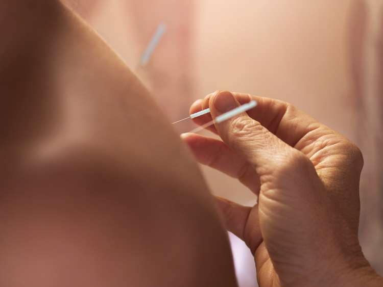 Women having acupuncture needles applied.